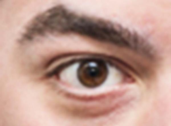 Entenda o que é o Glaucoma e saiba como tratar a doença